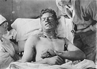 World War 1 Picture - A Canadian soldier with mustard gas burns, 1917/1918.